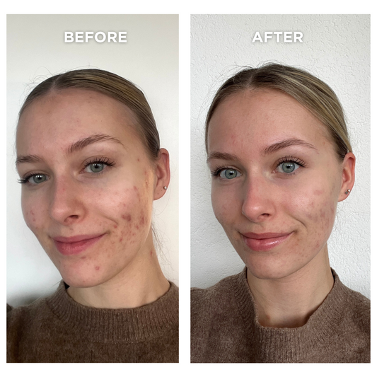 SET VOOR ACNE