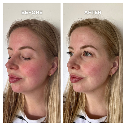 SET VOOR ROSACEA